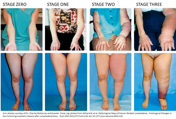 One in Three At-Risk Cancer Patients Develop Lymphedema, But It’s Not Inevitable